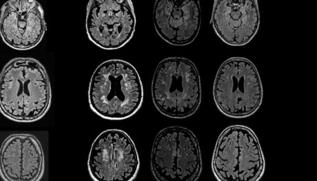 لکه های سفید مغز در تصاویر MRI