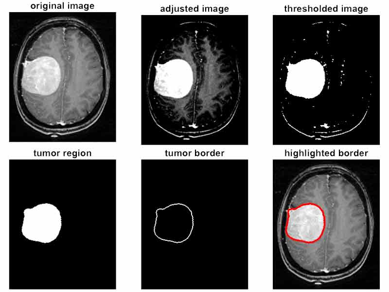 استخراج تومور در تصاویر MRI مغزی با کمک عملیات مورفولوژی
