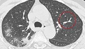 CT-COVID19 dataset