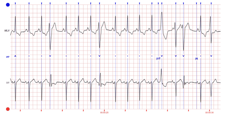 چارچوب انجام یک پروژه تشخیص آریتمی قلبی با سیگنال ECG؛ از داده تا ارزیابی مدل