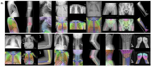ناحیه بندی تصاویر x-ray با یادگیری عمیق